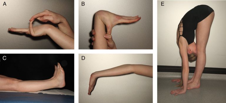 Hypermobility, and Physiotherapy 1 BJM Hypermobility 768x350 1
