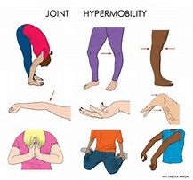 Hypermobility, and Physiotherapy 2 Hypermobility pic